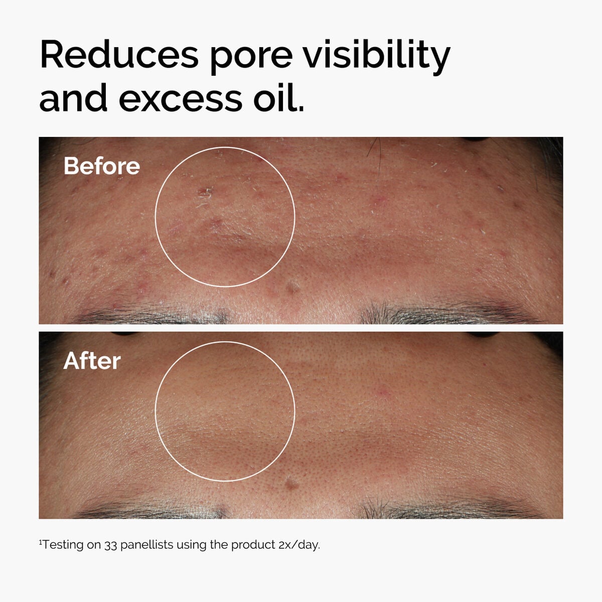 niacinamide-10-zinc-1-f9 ord-niacinamide-zinc-blemish-serum-before-after-pores.jpg