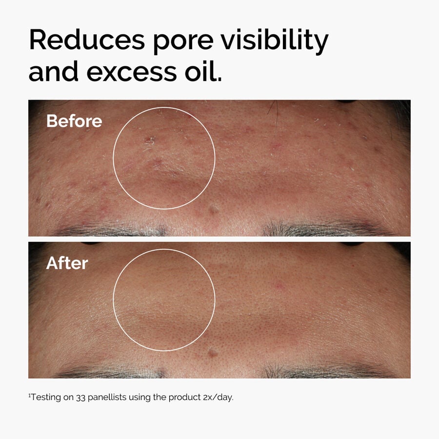 niacinamide-10-zinc-1-f9 ord-niacinamide-zinc-blemish-serum-before-after-pores.jpg